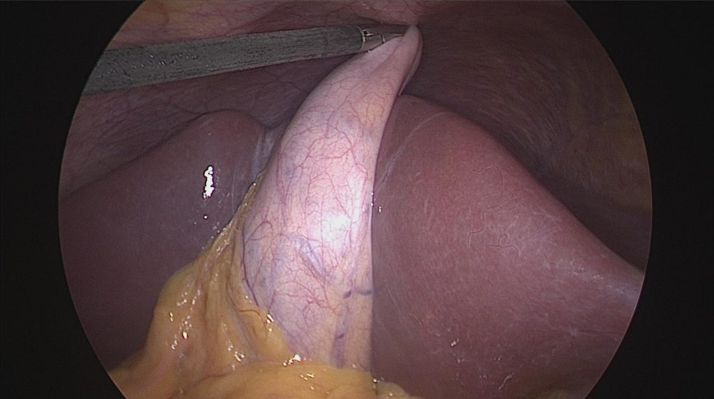  laparoscopic dissection of the gallbladder during cholecystectomy.