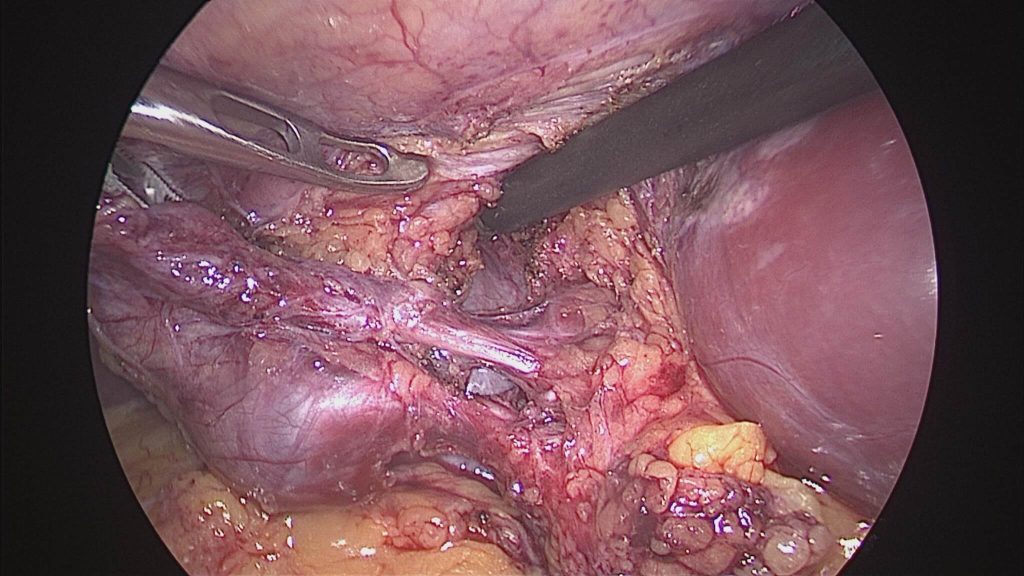 small abdominal incisions for laparoscopic cholecystectomy instruments.