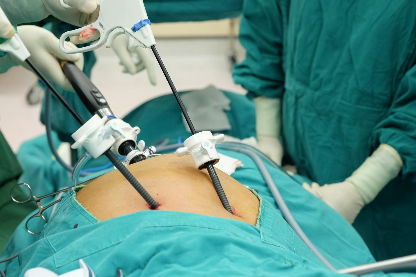 laparoscopic cholecystectomy surgical view of the gallbladder before removal Singapore.