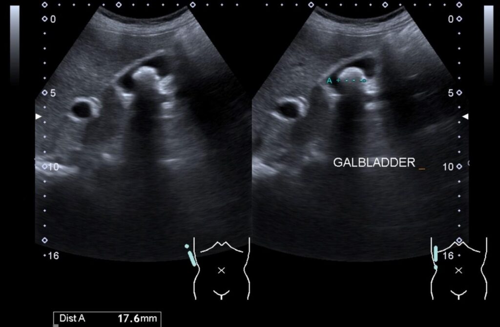 abdominal ultrasound gallstones two 1cm stones gallbladder Singapore.