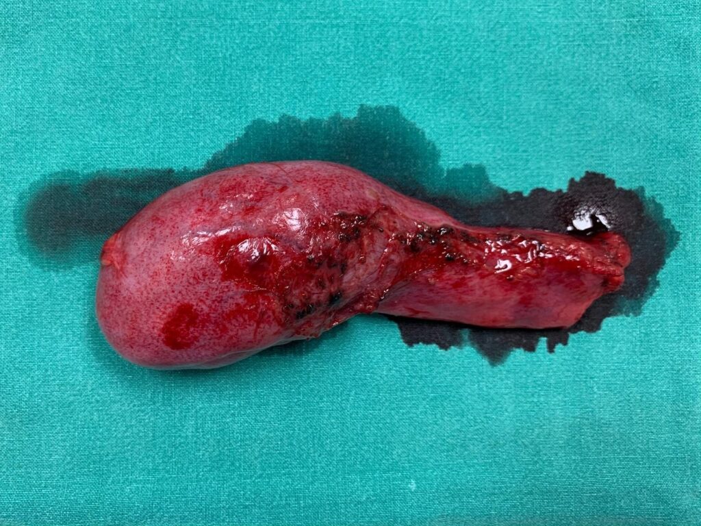 acute cholecystitis severe abdominal pain emergency admission Singapore gallstones.