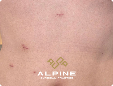 inflamed gallbladder removed during laparoscopic surgery in Singapore.