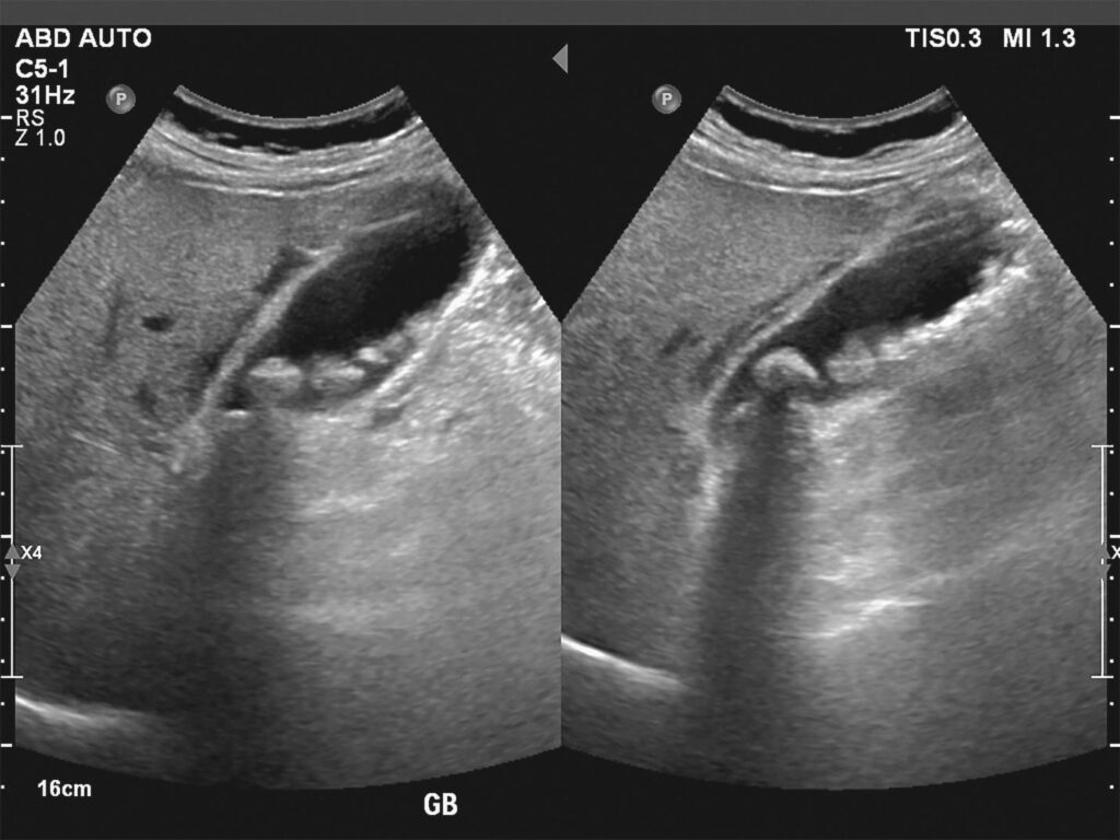 ultrasound diagnosis of gallstones Singapore.