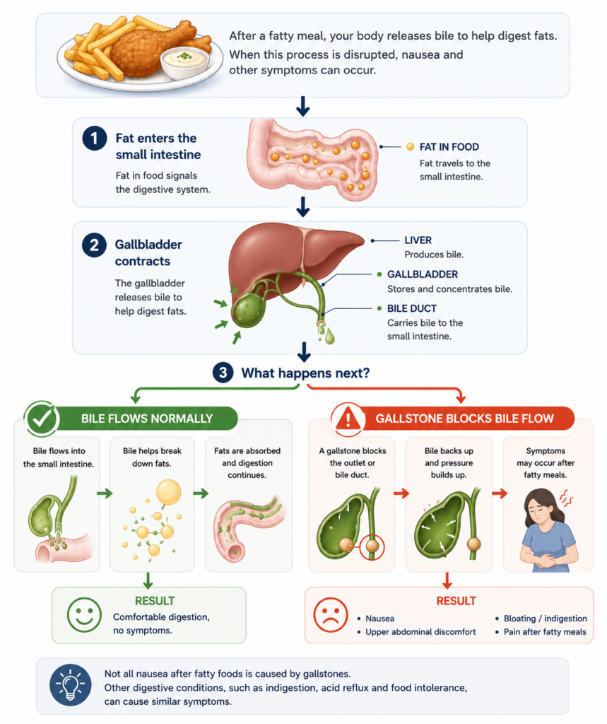 Medical infographic illustrating how fatty foods trigger bile release, comparing normal bile flow with gallstone obstruction that can lead to nausea, upper abdominal discomfort and pain after meals.