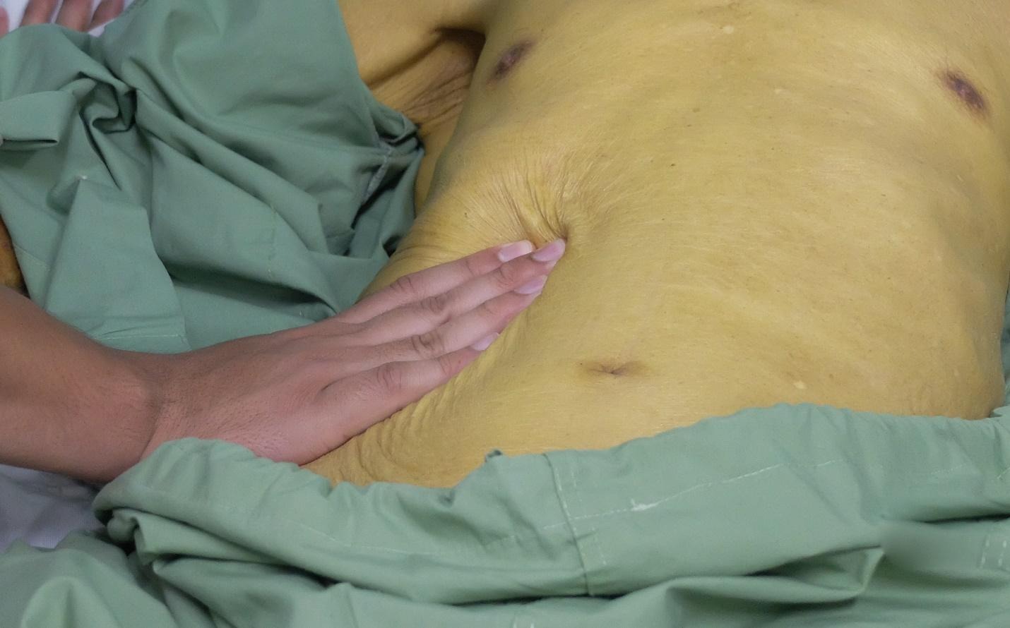 jaundice sign of bile duct obstruction.